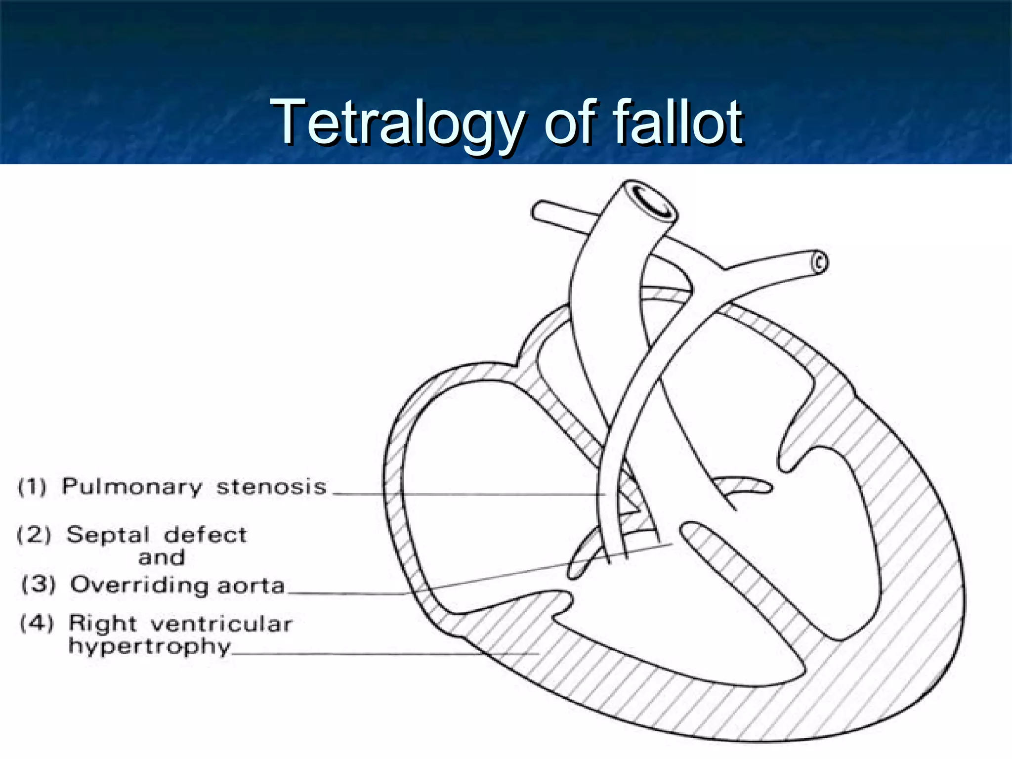 02/09/17
Tetralogy of fallotTetralogy of fallot
 