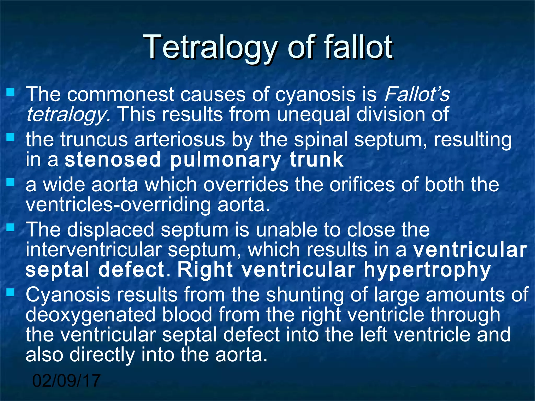 02/09/17
Tetralogy of fallotTetralogy of fallot
 The commonest causes of cyanosis is Fallot’s
tetralogy. This results from unequal division of
 the truncus arteriosus by the spinal septum, resulting
in a stenosed pulmonary trunk
 a wide aorta which overrides the orifices of both the
ventricles-overriding aorta.
 The displaced septum is unable to close the
interventricular septum, which results in a ventricular
septal defect. Right ventricular hypertrophy
 Cyanosis results from the shunting of large amounts of
deoxygenated blood from the right ventricle through
the ventricular septal defect into the left ventricle and
also directly into the aorta.
 