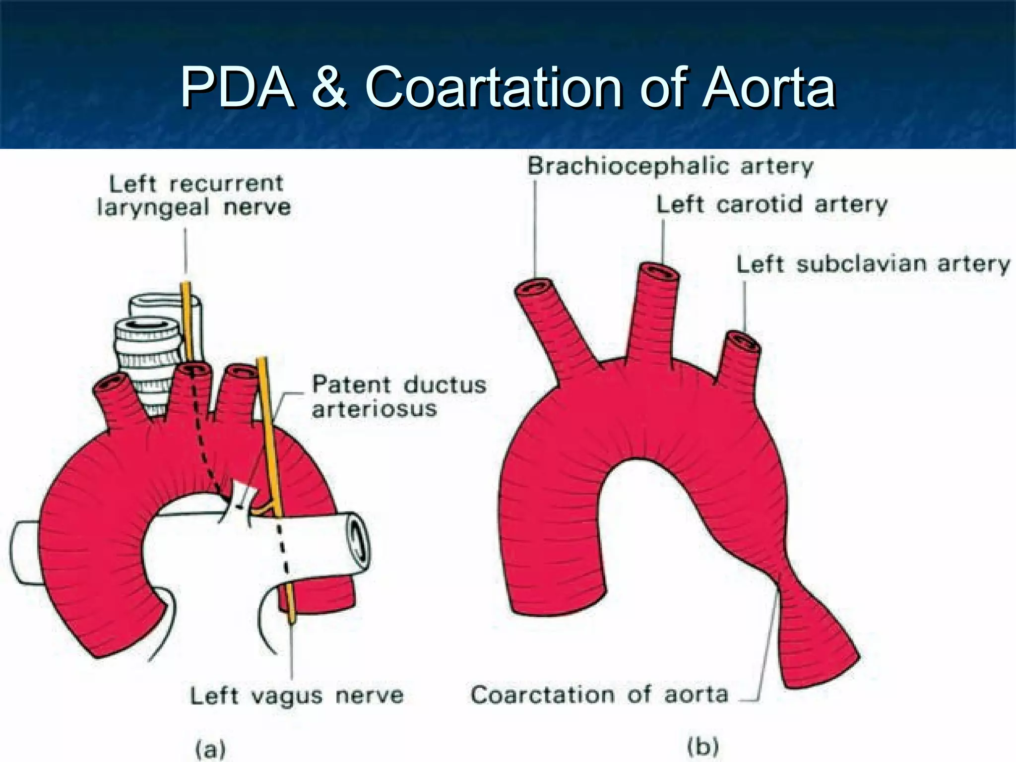 02/09/17
PDA & Coartation of AortaPDA & Coartation of Aorta
 