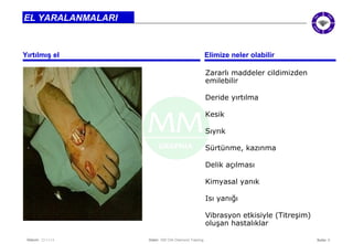 Seite: 9 
EL YARALANMALARI 
Yırtılmış el Elimize neler olabilir 
Datum: 22/11/14 Datei: 550 DIA Diamond Training 
Zararlı maddeler cildimizden 
emilebilir 
Deride yırtılma 
Kesik 
Sıyrık 
Sürtünme, kazınma 
Delik açılması 
Kimyasal yanık 
Isı yanığı 
Vibrasyon etkisiyle (Titreşim) 
oluşan hastalıklar 
 