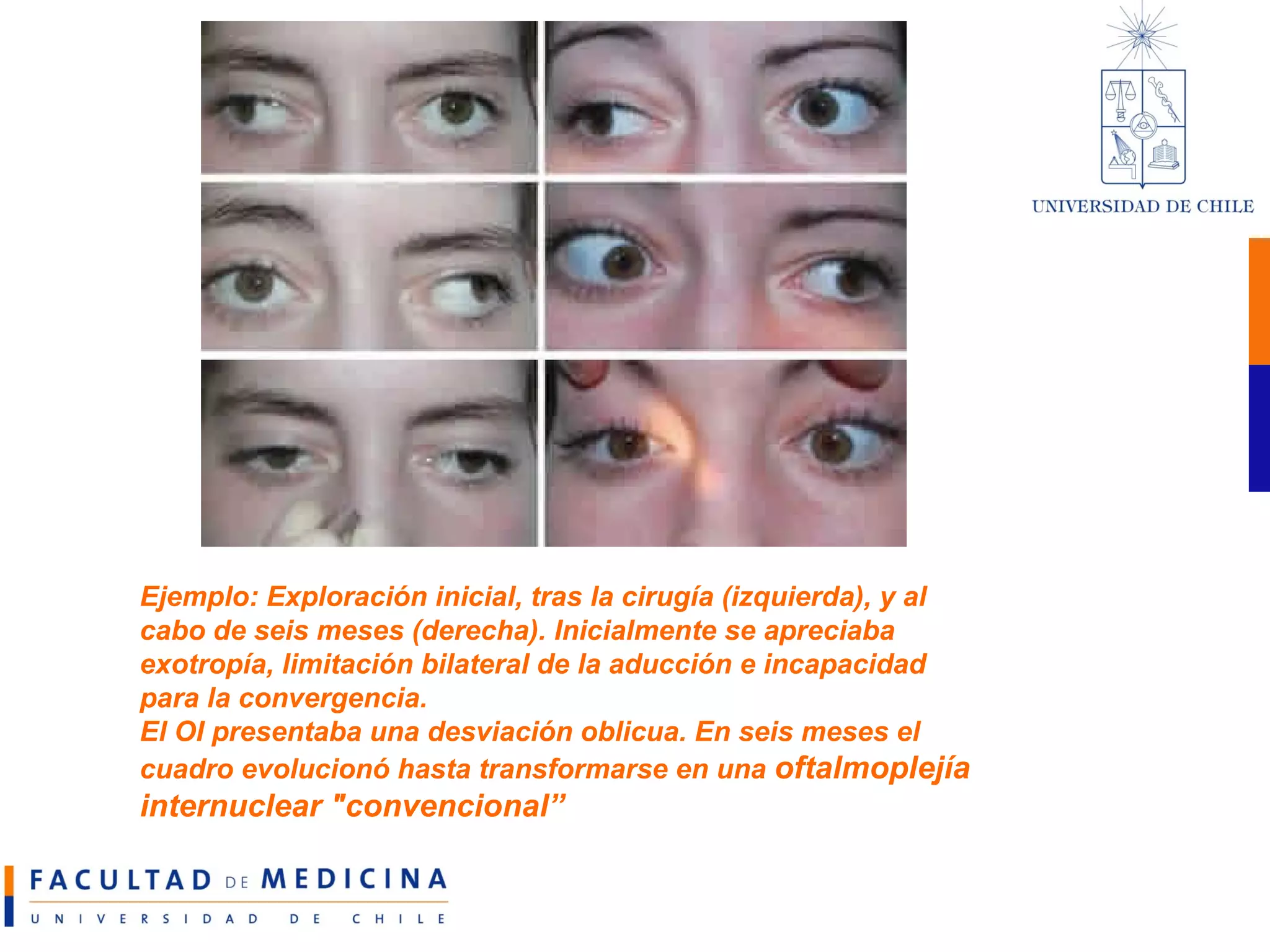 Ejemplo: Exploración inicial, tras la cirugía (izquierda), y al cabo de seis meses (derecha). Inicialmente se apreciaba exotropía, limitación bilateral de la aducción e incapacidad para la convergencia.  El OI presentaba una desviación oblicua. En seis meses el cuadro evolucionó hasta transformarse en una  oftalmoplejía internuclear "convencional”   