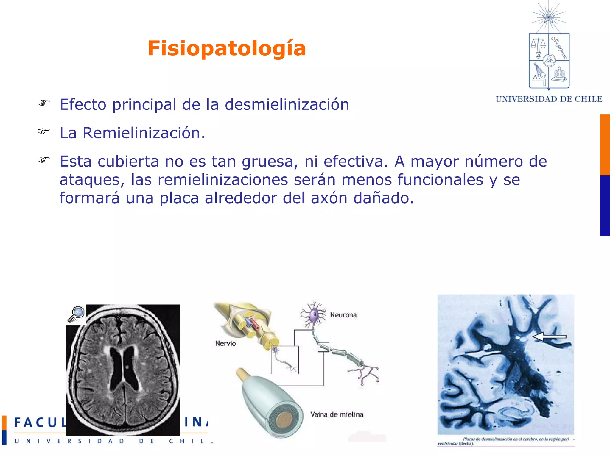 Fisiopatología Efecto principal de la desmielinización La Remielinización. Esta cubierta no es tan gruesa, ni efectiva. A mayor número de ataques, las remielinizaciones serán menos funcionales y se formará una placa alrededor del axón dañado.  
