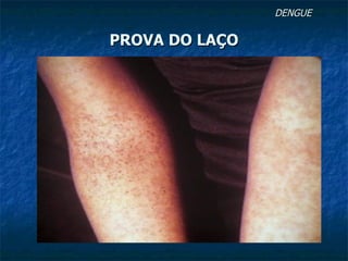 DENGUE  PROVA DO LAÇO 