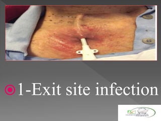 1-Exit site infection
 