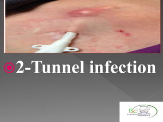 2-Tunnel infection
 
