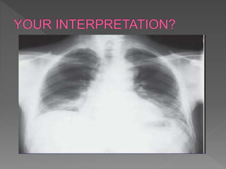 chest radiology in ICU