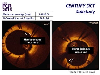 CENTURY OCT
Substudy
Homogeneous
neointima
Homogeneous
neointima
Courtesy H. Garcia Garcia
Mean strut coverage (mm) 0.080.04
% Covered Struts at 6 months 96.25.4
 