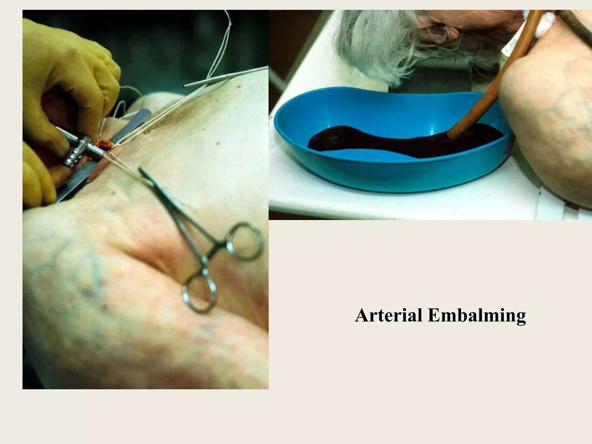 Arterial Embalming 
 