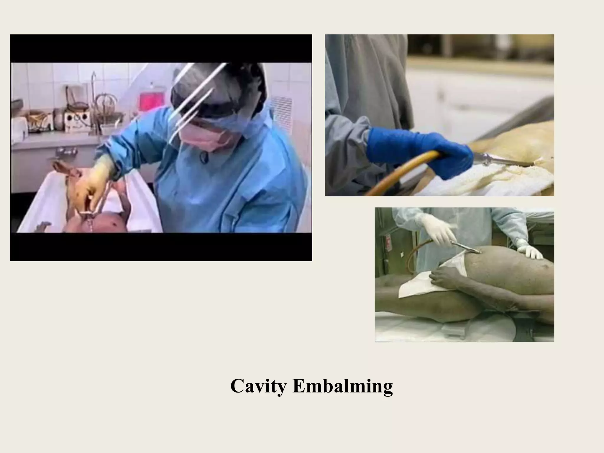 Cavity Embalming 
 