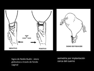 Signo de Noble Budín : útero
globuloso a través de fondo
vaginal

asimetría por implantación
cerca del cuerno

 