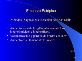 Embarzo Ectópico Métodos Diagnósticos: Reacción de Arias-Stella Aumento focal de las glándulas con núcleos hipercrómicicos e hipertróficos. Vascularización y pérdida de bordes celulares Aumento en el tamaño de los núclos NEFM 