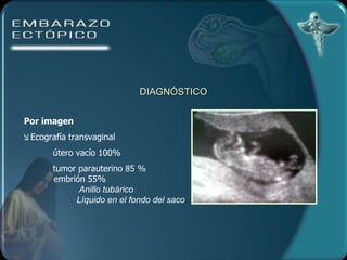 DIAGNÓSTICO Por imagen Ecografía transvaginal útero vacío 100% tumor parauterino 85 % embrión 55% Anillo tubárico Líquido en el fondo del saco 