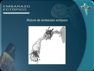 Rotura de embarazo ectópico 