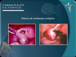 Rotura de embarazo ectópico 