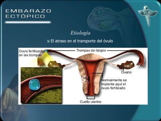 Etiología El atraso en el transporte del óvulo 