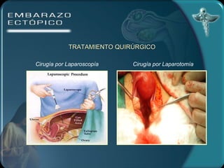 TRATAMIENTO QUIRÚRGICO Cirugía por Laparoscopía Cirugía por Laparotomía 