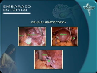 CIRUGÍA LAPAROSCÓPICA 