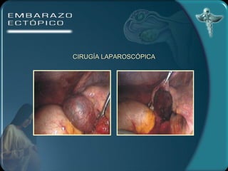 CIRUGÍA LAPAROSCÓPICA 