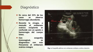 Embarazo-ectópico final.pptx