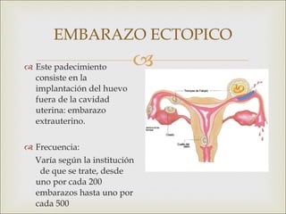 Embarazo ectopico