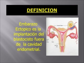 <ul><ul><li>Embarazo Ectopico es la  implantación del blastocisto fuera de  la cavidad endometrial. </li></ul></ul>