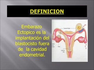 Embarazo Ectopico es la  implantación del blastocisto fuera de  la cavidad endometrial. 