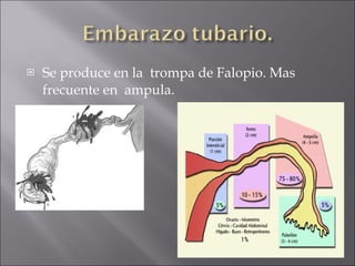 Se produce en la  trompa de Falopio. Mas frecuente en  ampula. 