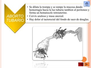 ABORTO
TUBARIO

• Se dilata la trompa y se rompe la mucosa dando
hemorragia hacia la luz tubaria tambien al peritoneo y
forma un hematocele retrouterino.
• Cervix azuloso y masa anexial.
• Hay dolor al tactorectal del fondo de saco de douglas.

 