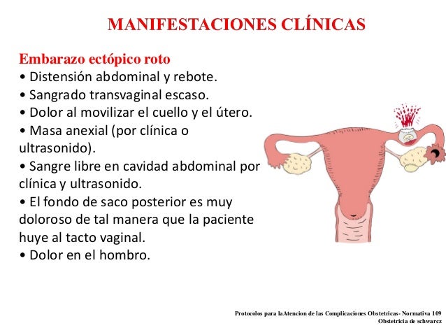 Embarazo ectopico