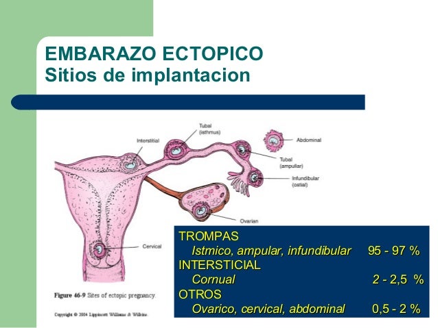 Embarazo ectopico