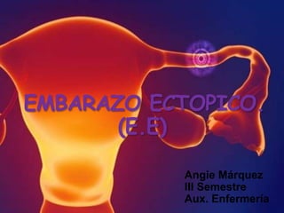 EMBARAZO ECTOPICO.
(E.E)
Angie Márquez
III Semestre
Aux. Enfermería
 