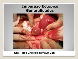Embarazo Ect
Embarazo Ectó
ópico
pico
Generalidades
Generalidades
Dra. Tania Graciela Tamayo Lien
 