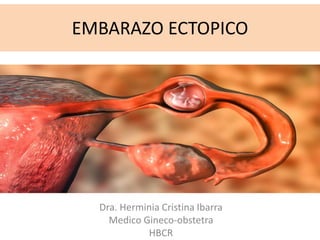EMBARAZO ECTOPICO
Dra. Herminia Cristina Ibarra
Medico Gineco-obstetra
HBCR
 