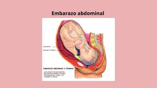 Embarazo abdominal
 