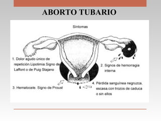 ABORTO TUBARIO
 