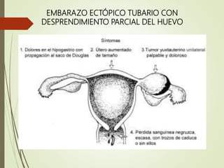 embarazoectopico