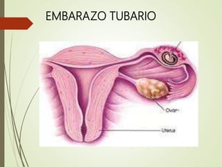 embarazoectopico