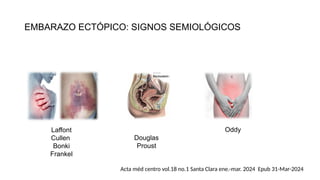 EMBARAZO ECTÓPICO: SIGNOS SEMIOLÓGICOS
Laffont
Cullen
Bonki
Frankel
Douglas
Proust
Oddy
Acta méd centro vol.18 no.1 Santa Clara ene.-mar. 2024 Epub 31-Mar-2024
 