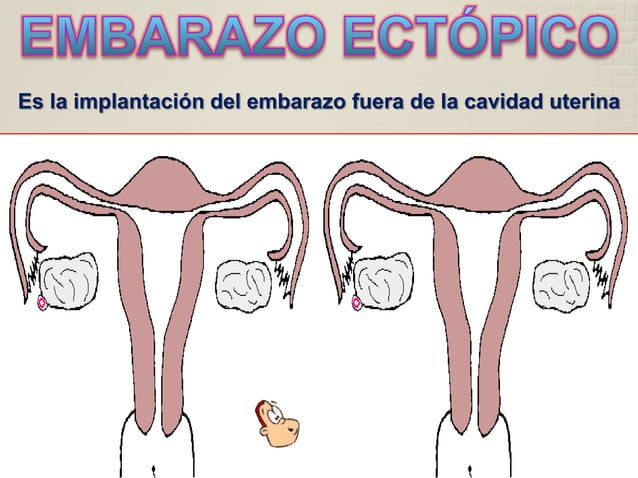 Embarazo Ectopico Cuidados de enfermería | PPT