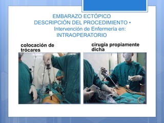 EMBARAZO ECTÓPICO
DESCRIPCIÓN DEL PROCEDIMIENTO •
Intervención de Enfermería en:
INTRAOPERATORIO
colocación de
trócares
cirugía propiamente
dicha
 