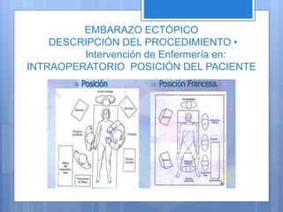 EMBARAZO ECTÓPICO
DESCRIPCIÓN DEL PROCEDIMIENTO •
Intervención de Enfermería en:
INTRAOPERATORIO POSICIÓN DEL PACIENTE
 