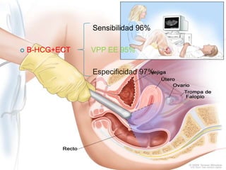 Sensibilidad 96%
 Β-HCG+ECT VPP EE 95%
Especificidad 97%
 