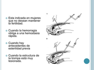  Esta indicada en mujeres
que no desean mantener
la fertilidad.
 Cuando la hemorragia
obliga a una hemostasia
rápida.
 Cuando hay
antecedentes de
esterilidad previa
 Cuando la estructura de
la trompa está muy
lesionada.
 