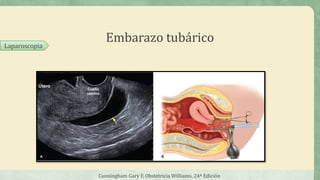 Embarazo tubárico
Cunningham Gary F, Obstetricia Williams. 24ª Edición
Laparoscopia
 
