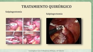 TRATAMIENTO QUIRÚRGICO
Salpingostomía
Cunningham Gary F, Obstetricia Williams. 24ª Edición
Salpingectomía
 