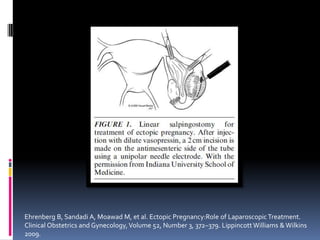 Ehrenberg B, Sandadi A, Moawad M, et al. Ectopic Pregnancy:Role of Laparoscopic Treatment.
Clinical Obstetrics and Gynecol...