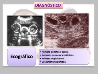 • Número de fetos y sexos.
• Números de sacos amnióticos.
• Número de placentas.
• Descartar fetos unidos.
Ecográfico
 