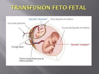 TRANSFUSIÓN FETO-FETALTRANSFUSIÓN FETO-FETAL
 