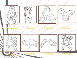 Prosopópago   Dicépago     Cefalópago   Onfalópago




 Piópago      Isquiópago   Craneópago   Toracópago
 