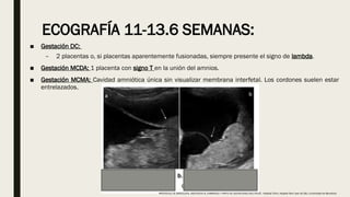 ECOGRAFÍA 11-13.6 SEMANAS:
■ Gestación DC:
– 2 placentas o, si placentas aparentemente fusionadas, siempre presente el signo de lambda.
■ Gestación MCDA: 1 placenta con signo T en la unión del amnios.
■ Gestación MCMA: Cavidad amniótica única sin visualizar membrana interfetal. Los cordones suelen estar
entrelazados.
PROTOCOLO DE BARCELONA, ASISTENCIA AL EMBARAZO Y PARTO DE GESTACIONES MULTIPLES . Hospital Clinic, Hospital Sant Joan de Déu, Universidad de Barcelona.
 